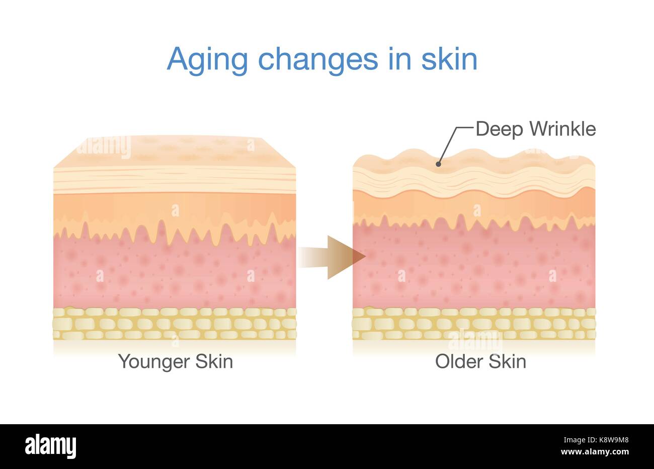 Alterung Veränderungen der Haut Stock Vektor