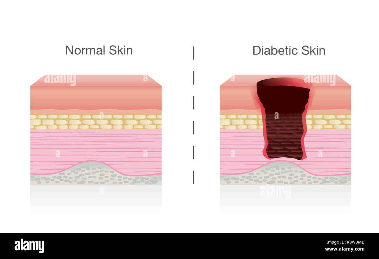 Der Unterschied zwischen der normalen Haut und diabetische Haut Bedingungen vergleichen. Stock Vektor