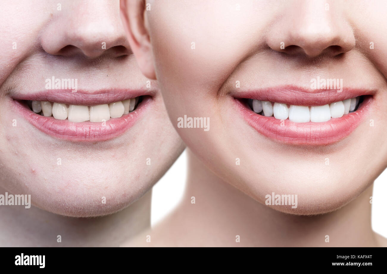 Zähne der jungen Frau vor und nach weiß werden. Stockfoto