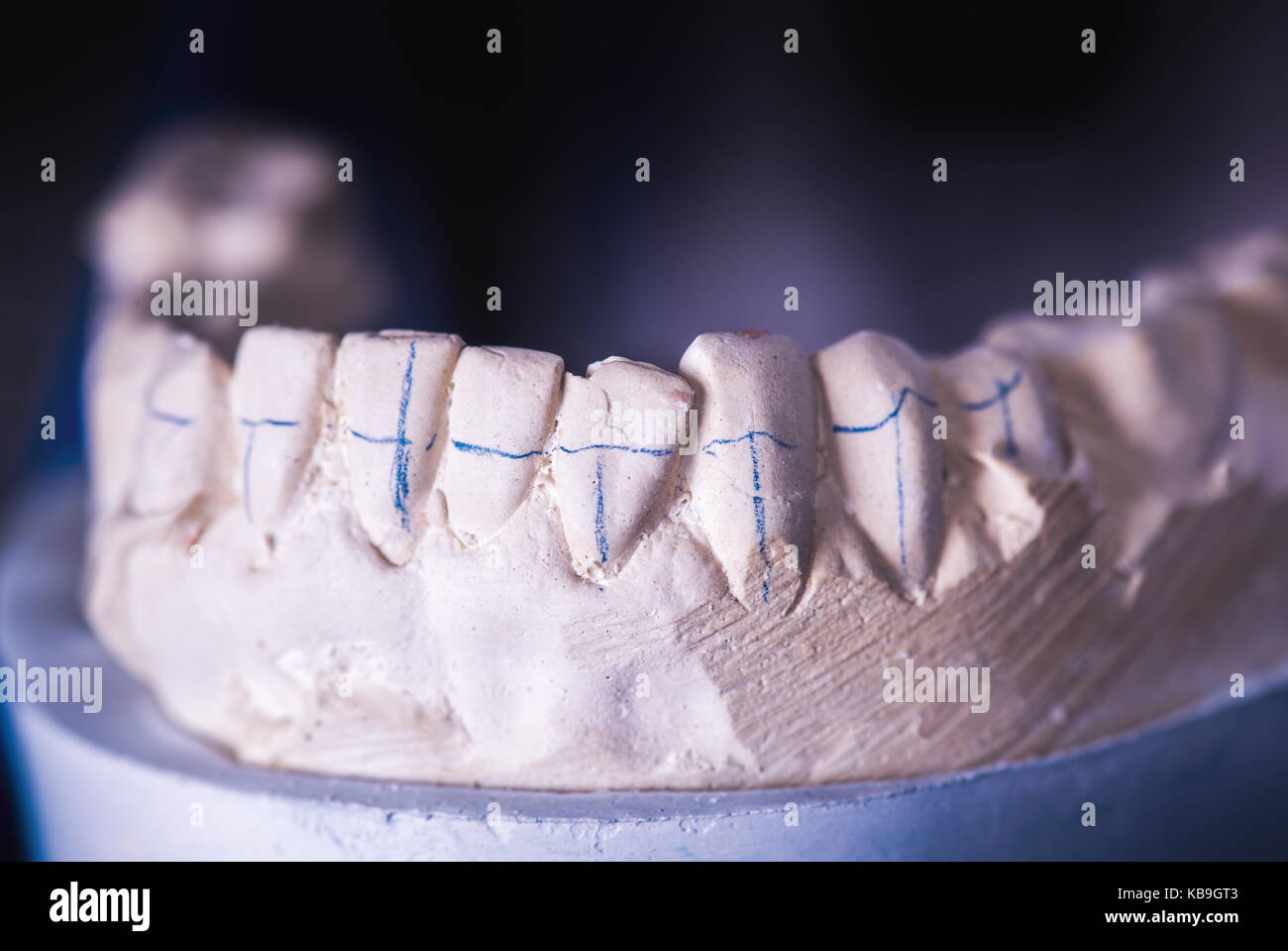 Zahnersatz, künstliche Zahn. Foto von künstlichen Zähnen im zahntechnischen Labor angefertigt. Stockfoto