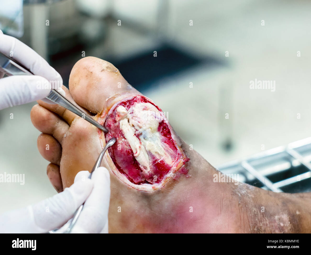 Diabetischer Wunden oft langsam zu heilen benötigen medizinische Betreuung und Überwachung, Infektionen des Diabetischen Fußes Stockfoto