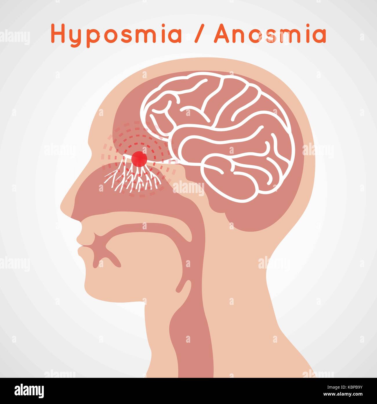 Дышишь но не чувствуешь запахов. Потеря обоняния. Аносмия (потеря обоняния). Обонятельная аносмия. Аносмия и гипосмия.