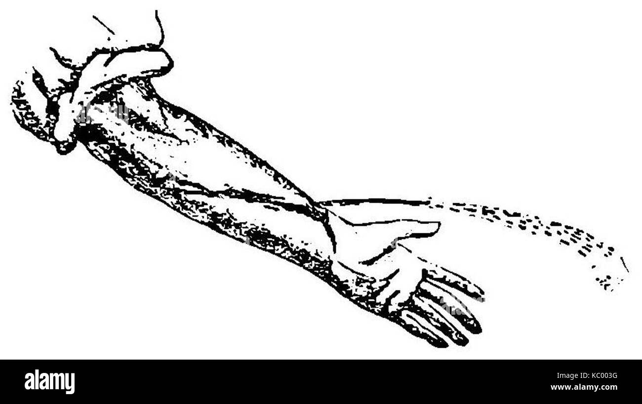 Grierson 59 Brazo con hemorragia arteriellen Stockfoto