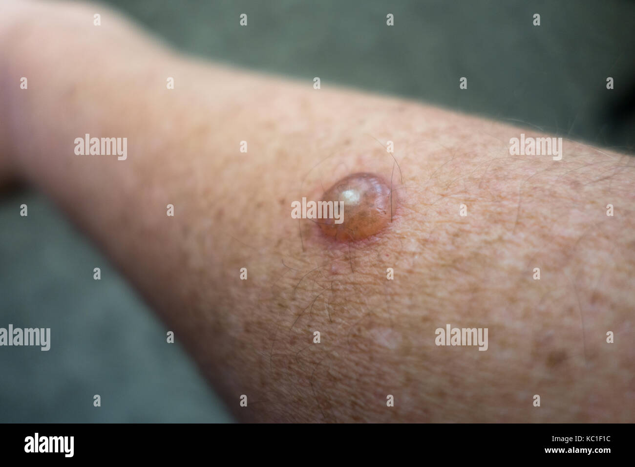 Eine Blase auf einem Arm durch den Einsatz von flüssigem Stickstoff erstellt - cryotheraphy - ein gutartiger Haut Wachstum zu entfernen. Stockfoto