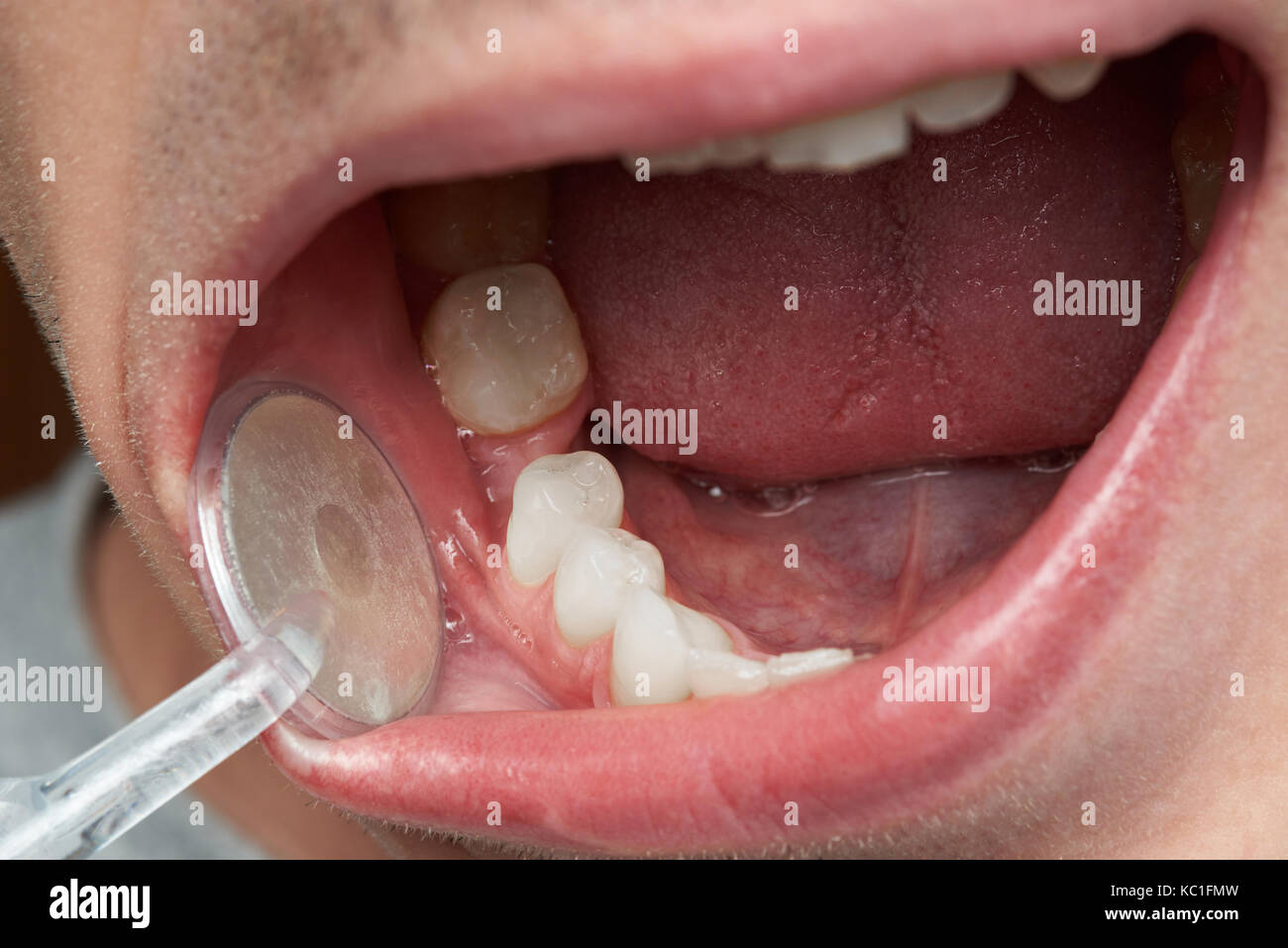 Zahnarzt Kontrolle mann Zähne close-up. Makro des offenen Mund Stockfoto