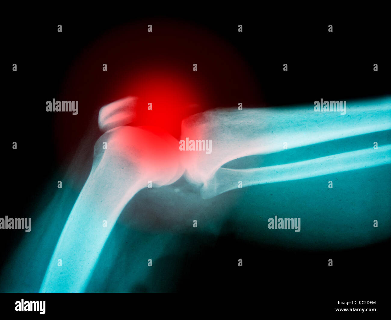 X-ray von menschlichen Arm mit gebrochenen Knochen mit rot markieren Stockfoto