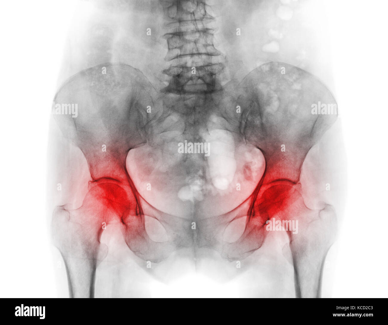 Film x-ray Becken der Osteoporose Patienten und Arthritis sowohl hip. Stockfoto