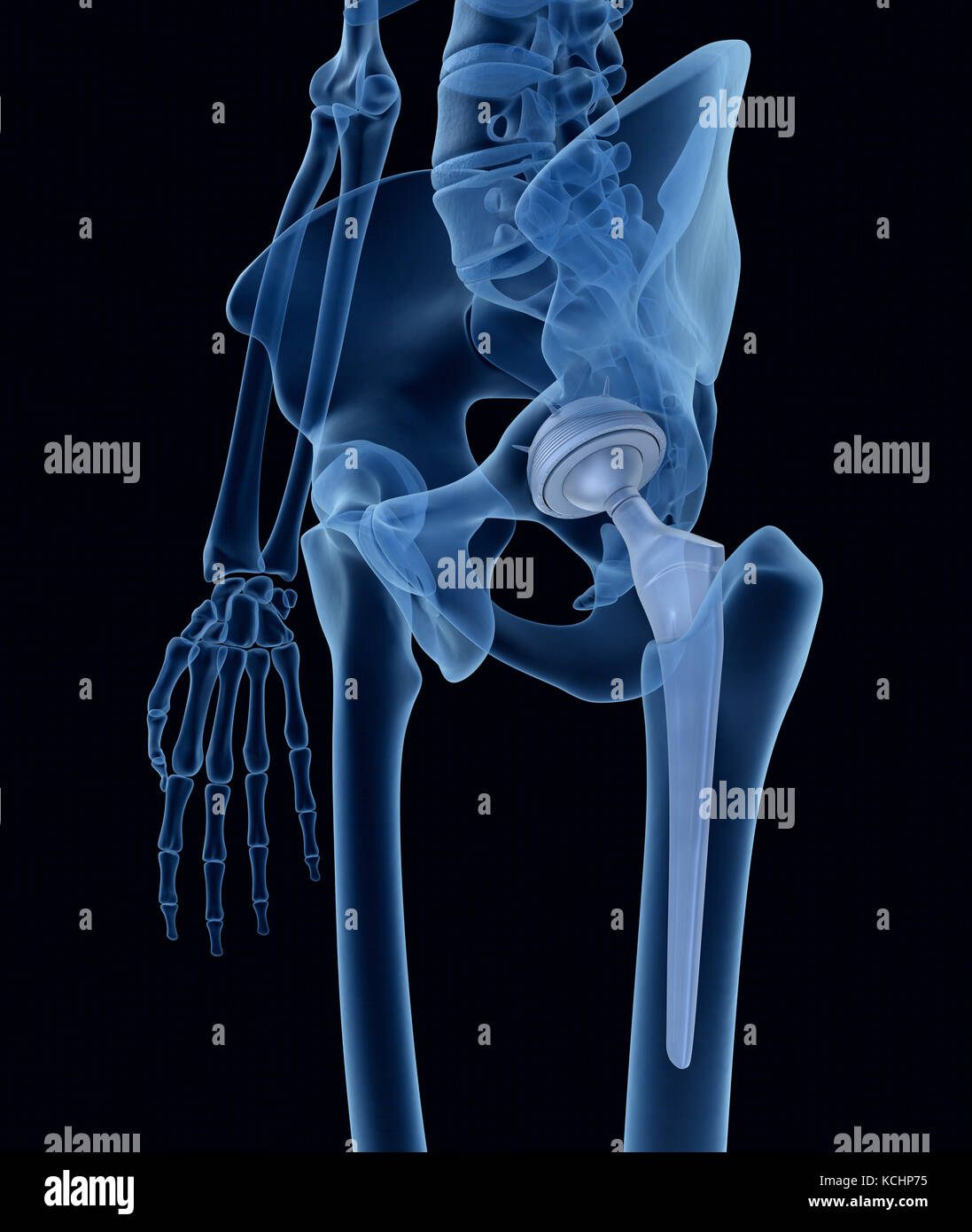 Pelvic Surgery Stockfotos & Pelvic Surgery Bilder - Alamy