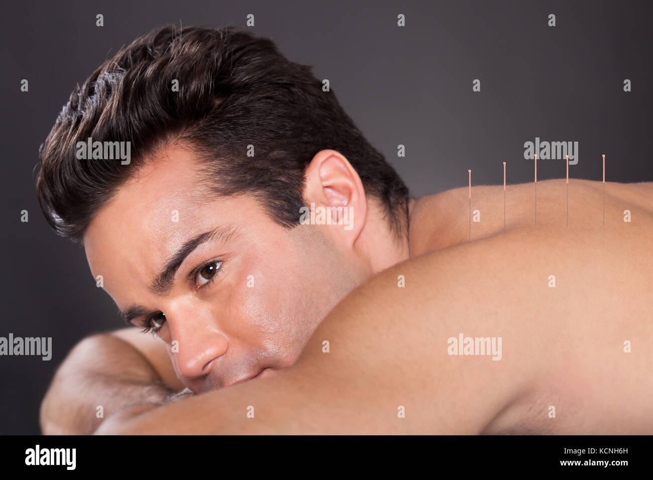 Nahaufnahme eines jungen Mannes, der Akupunktur Behandlung im Spa Stockfoto