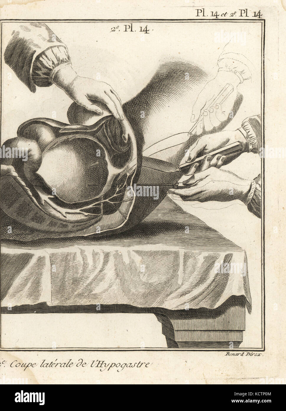 Foubert der chirurgischen Eingriff eine Blase Stein zu entfernen. Seitlicher Schnitt im hypogastrium, zeigt die Richtung und Bewegung der Skalpell in der Blase. Kupferstich von Robert Benard von Denis Diderots Enzyklopädie, Pellets, Genf, 1779. Stockfoto