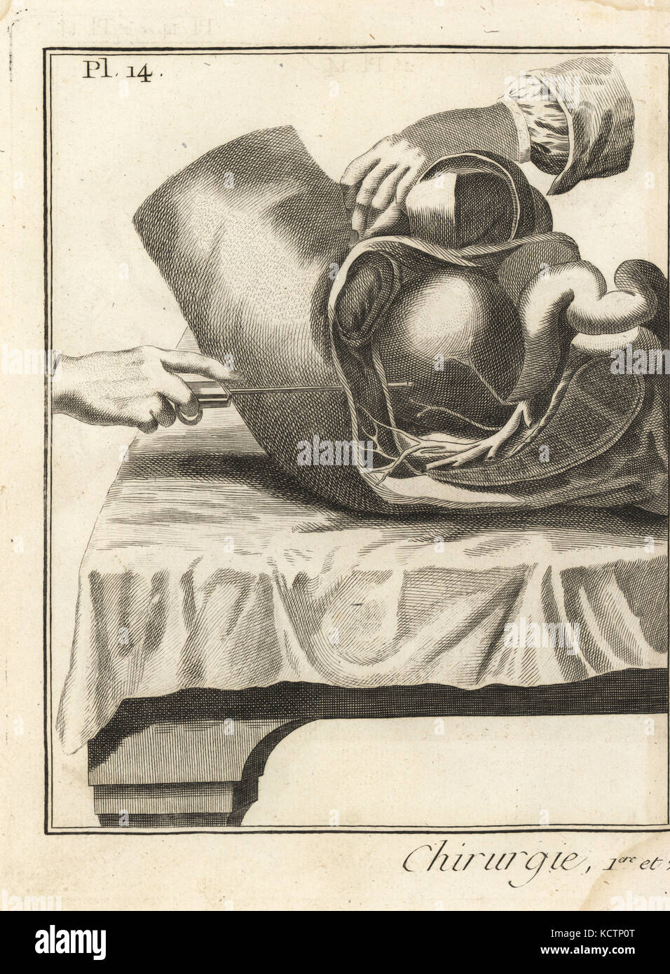 Foubert der chirurgischen Eingriff eine Blase Stein zu entfernen. Seitlicher Schnitt im hypogastrium, zeigt die Richtung der Trokar in der Blase. Kupferstich von Robert Benard von Denis Diderots Enzyklopädie, Pellets, Genf, 1779. Stockfoto