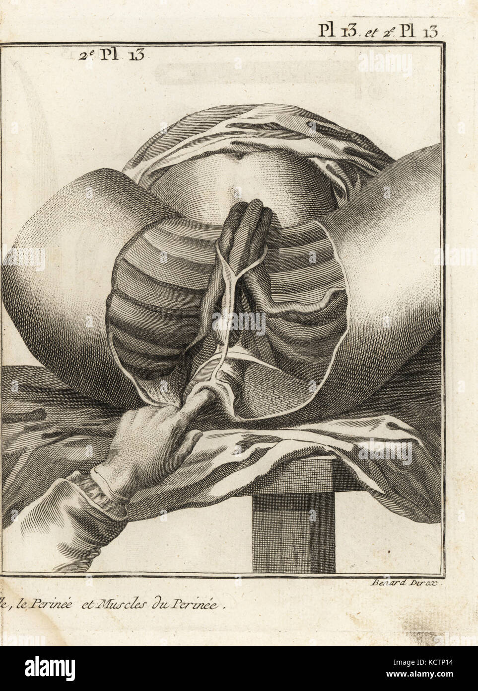 Foubert der chirurgischen Eingriff eine Blase Stein zu entfernen. Die Muskeln des perineum in ein Thema von 16 oder 17 Jahren. Kupferstich von Robert Benard von Denis Diderots Enzyklopädie, Pellets, Genf, 1779. Stockfoto