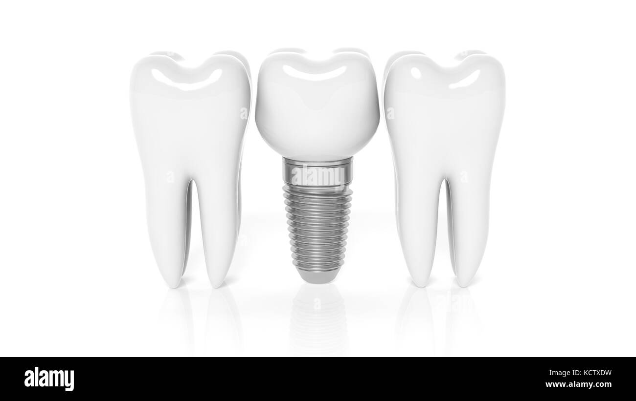 Reihe von Zähnen mit zahnmedizinischen auf weißem Hintergrund Implantat Stockfoto