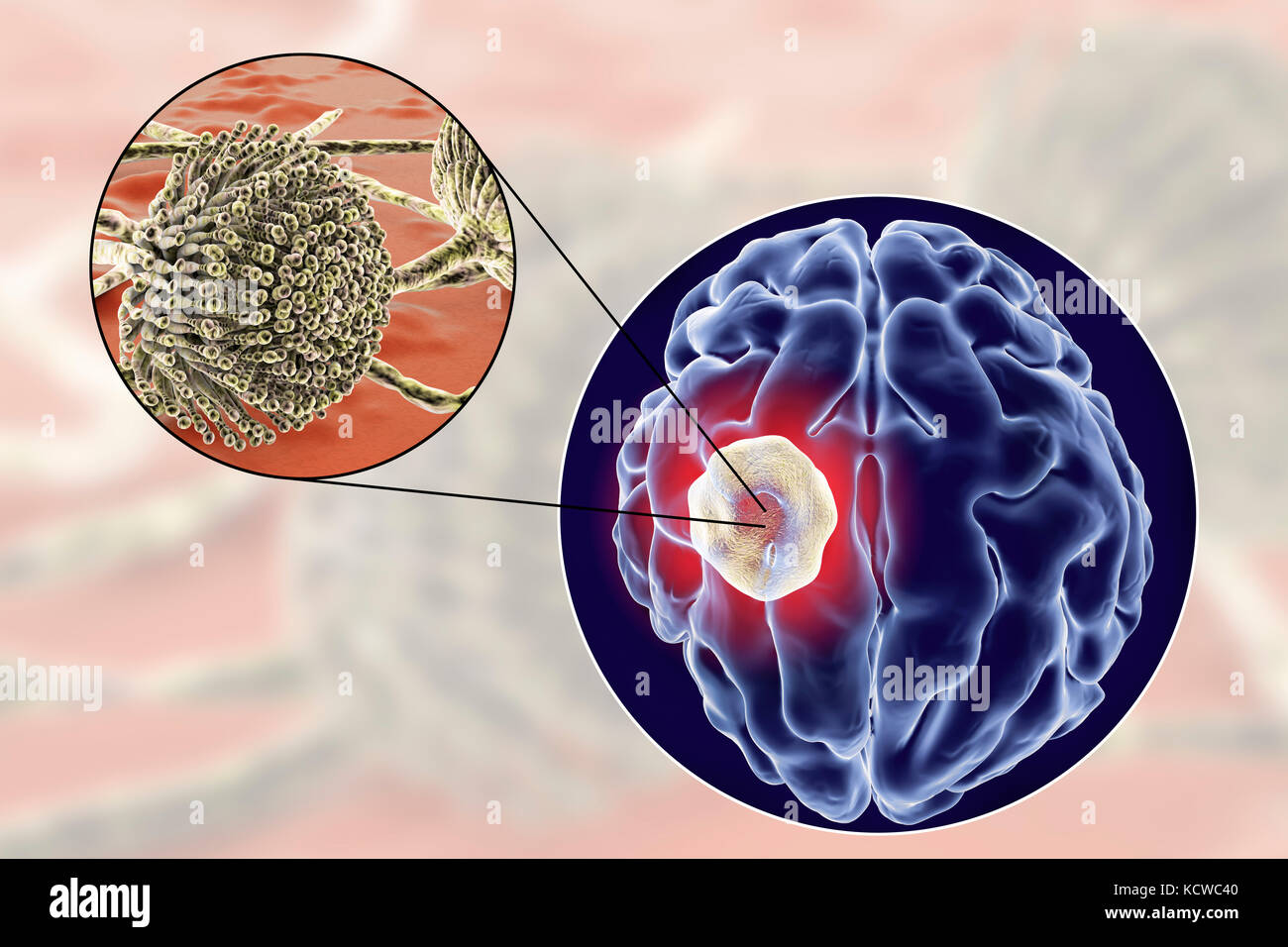 Aspergilloma des Gehirns und Nahaufnahme von Aspergillus Pilze, computer Abbildung. Auch als myzetom oder Pilz ball bekannt, dies ist eine intrakranielle Läsion durch Aspergillus Pilze bei immunsupprimierten Patienten hergestellt. Stockfoto