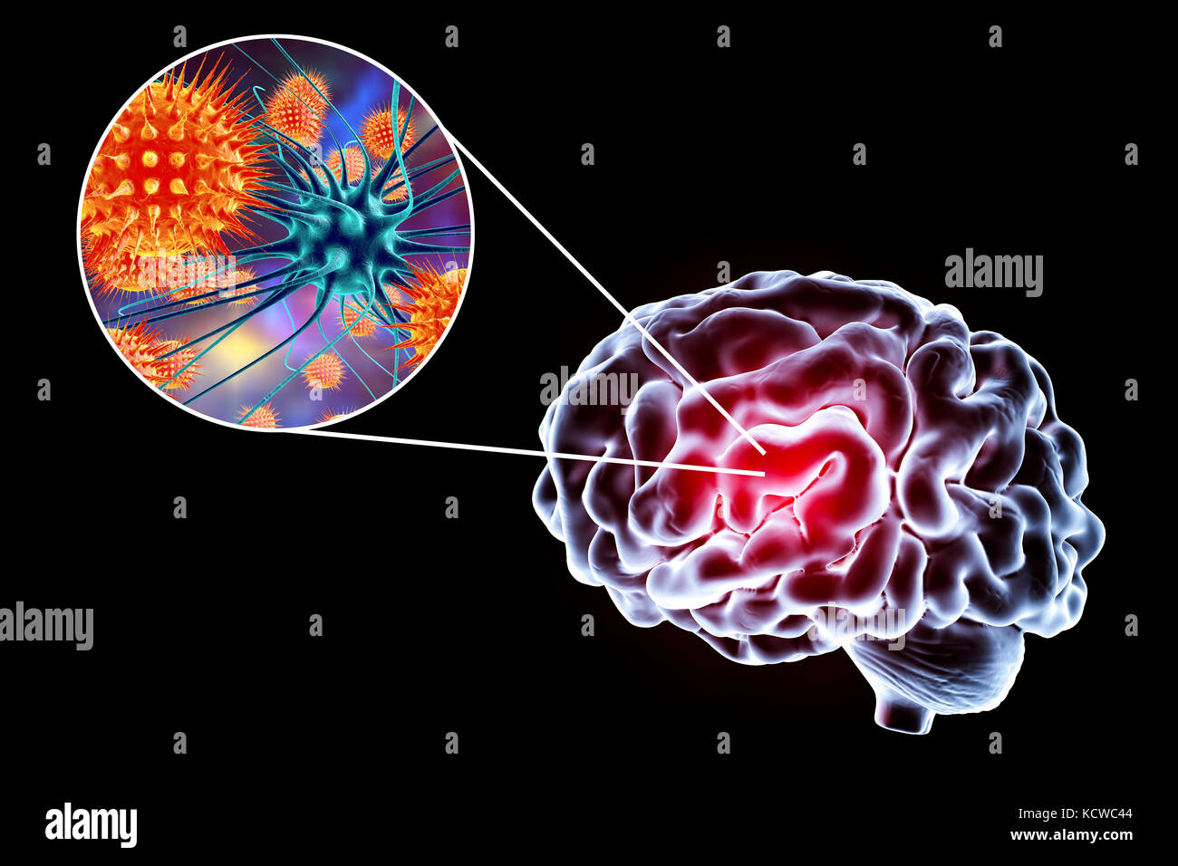 Virale Enzephalitis. Konzeptionelle Abbildung: Gehirn und Nahaufnahme der Viren Nervenzellen zu infizieren. Stockfoto