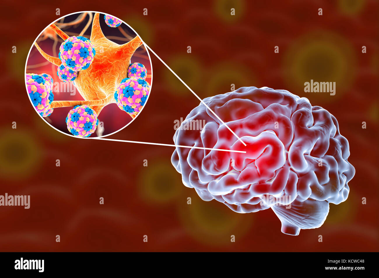 Virale Enzephalitis. Konzeptionelle Abbildung: Gehirn und Nahaufnahme der Viren Nervenzellen zu infizieren. Stockfoto
