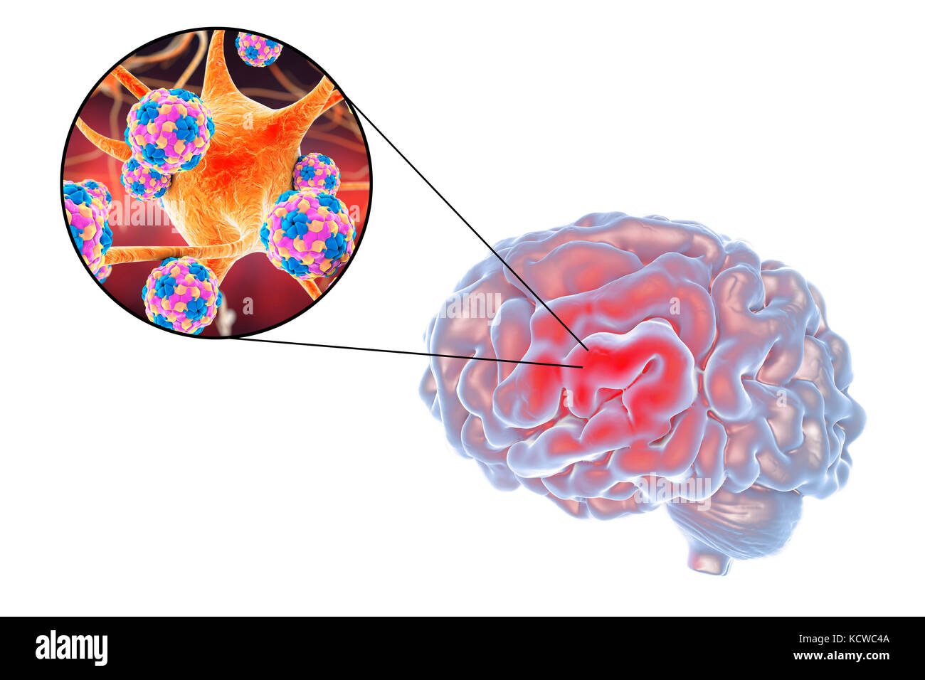 Virale Enzephalitis. Konzeptionelle Abbildung: Gehirn und Nahaufnahme der Viren Nervenzellen zu infizieren. Stockfoto