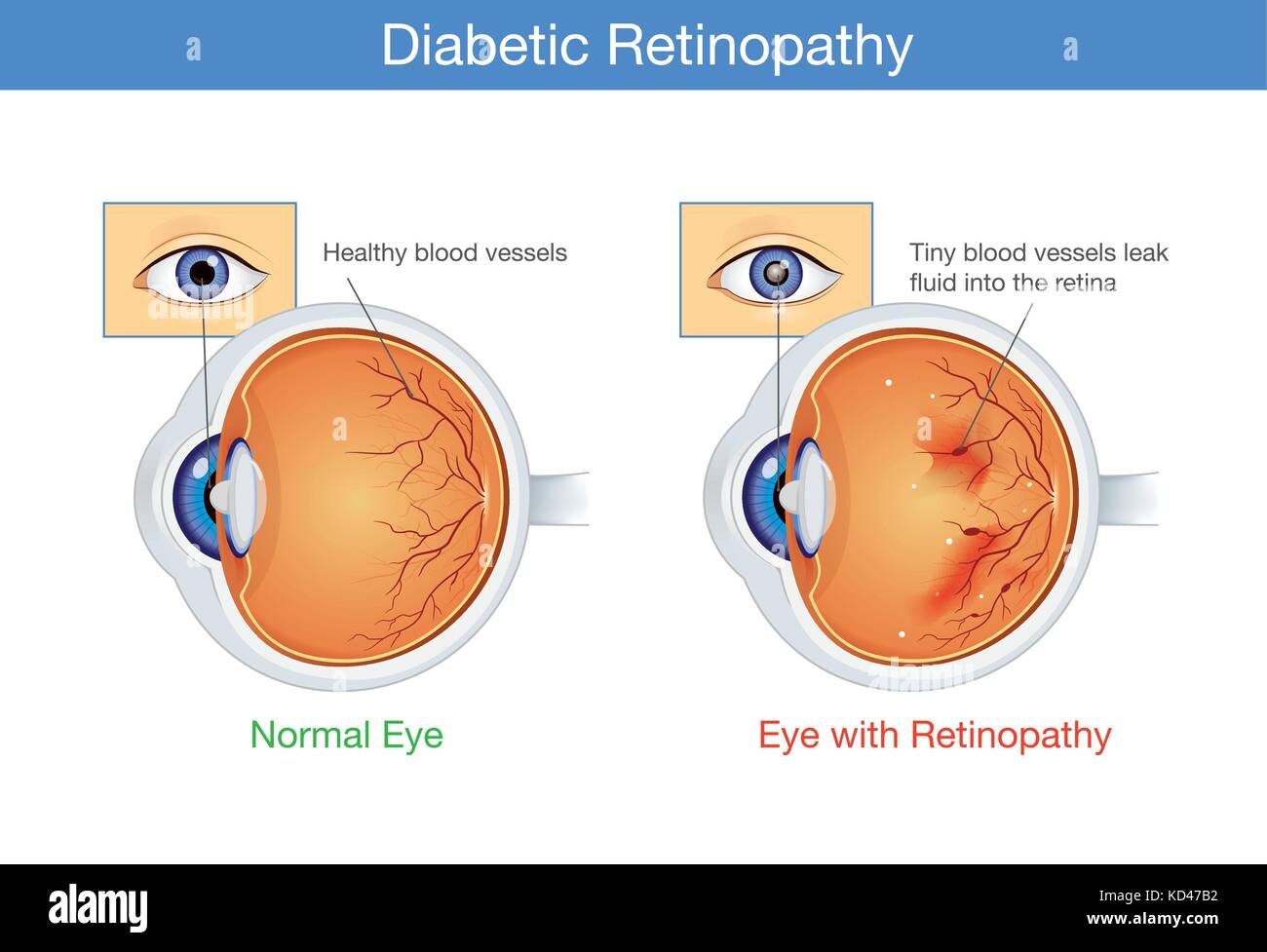 Anatomie des normalen Auges und diabetischer Retinopathie. Stock Vektor