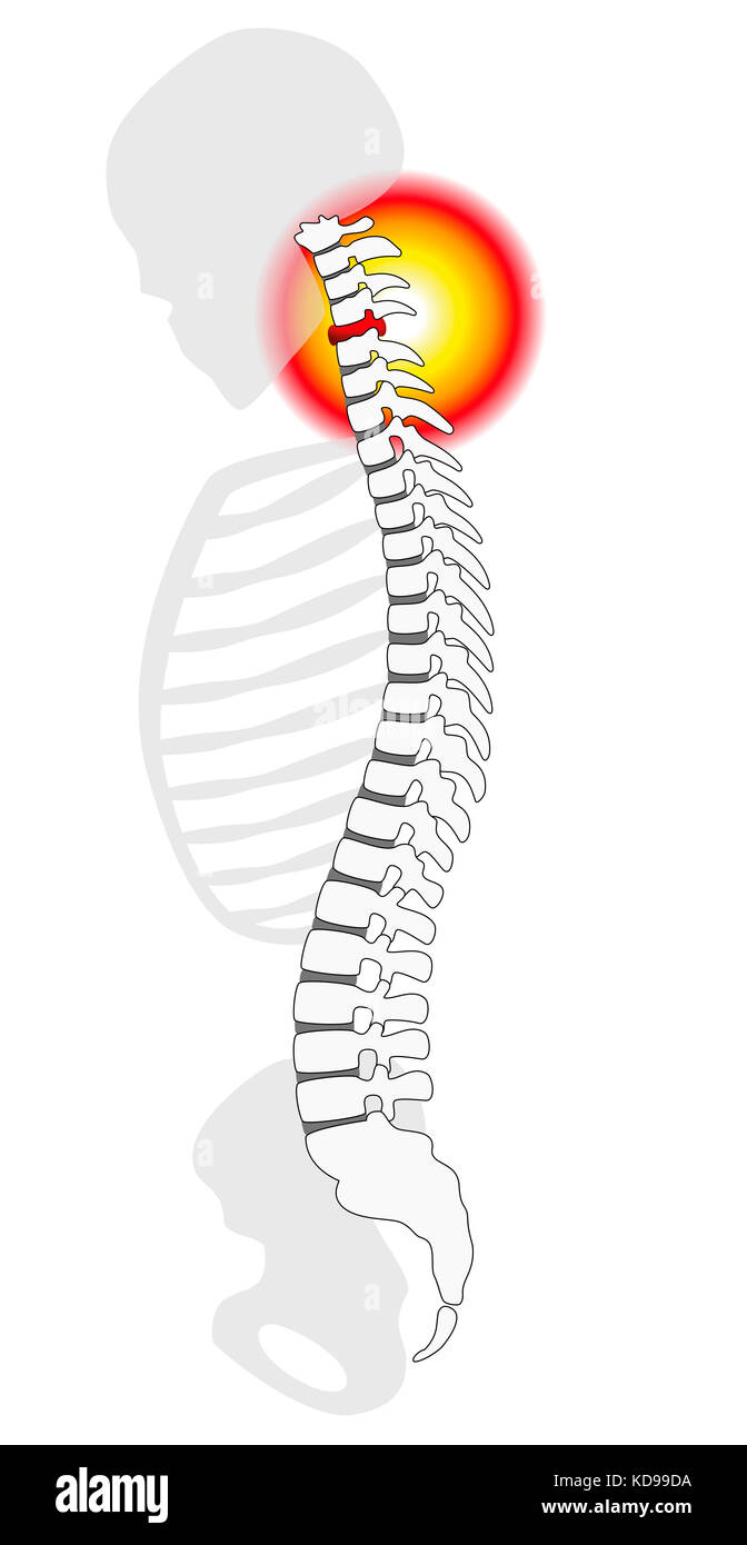 Nackenschmerzen - wirbelsäule Bandscheibenvorfall oder Prolaps auf der menschlichen Halswirbel - Profil anzeigen. Abbildung auf weißen Hintergrund. Stockfoto
