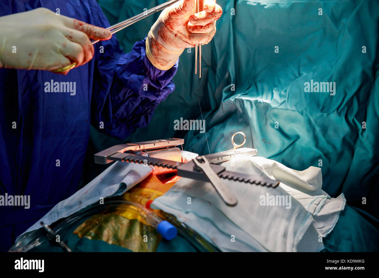 Offenes Herz Herz Bypass Chirurgie in Betrieb zimmer Operation am offenen Herzen Stockfotografie