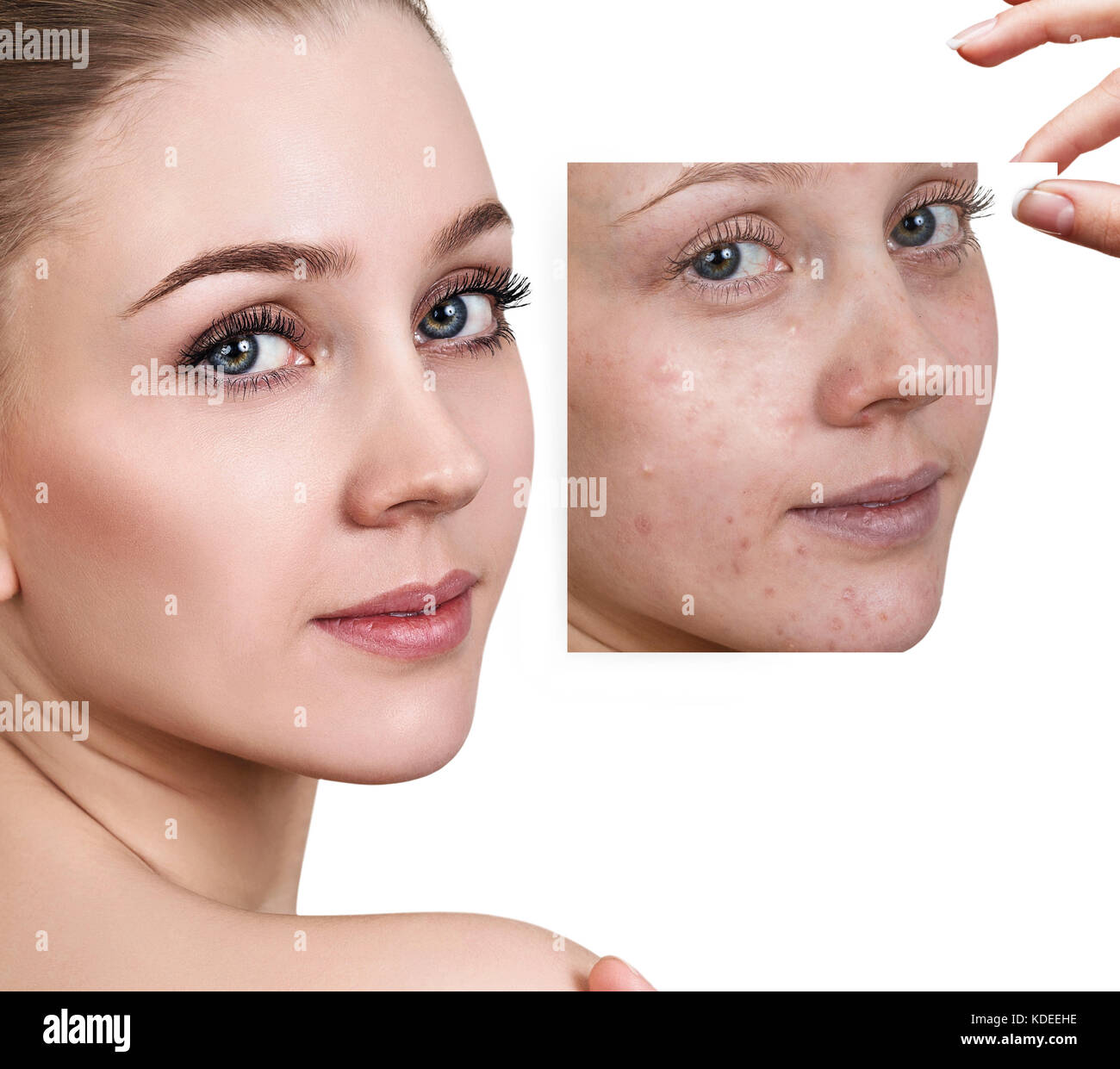 Frau zeigt Foto mit schlechter Haut vor der Behandlung. Stockfoto