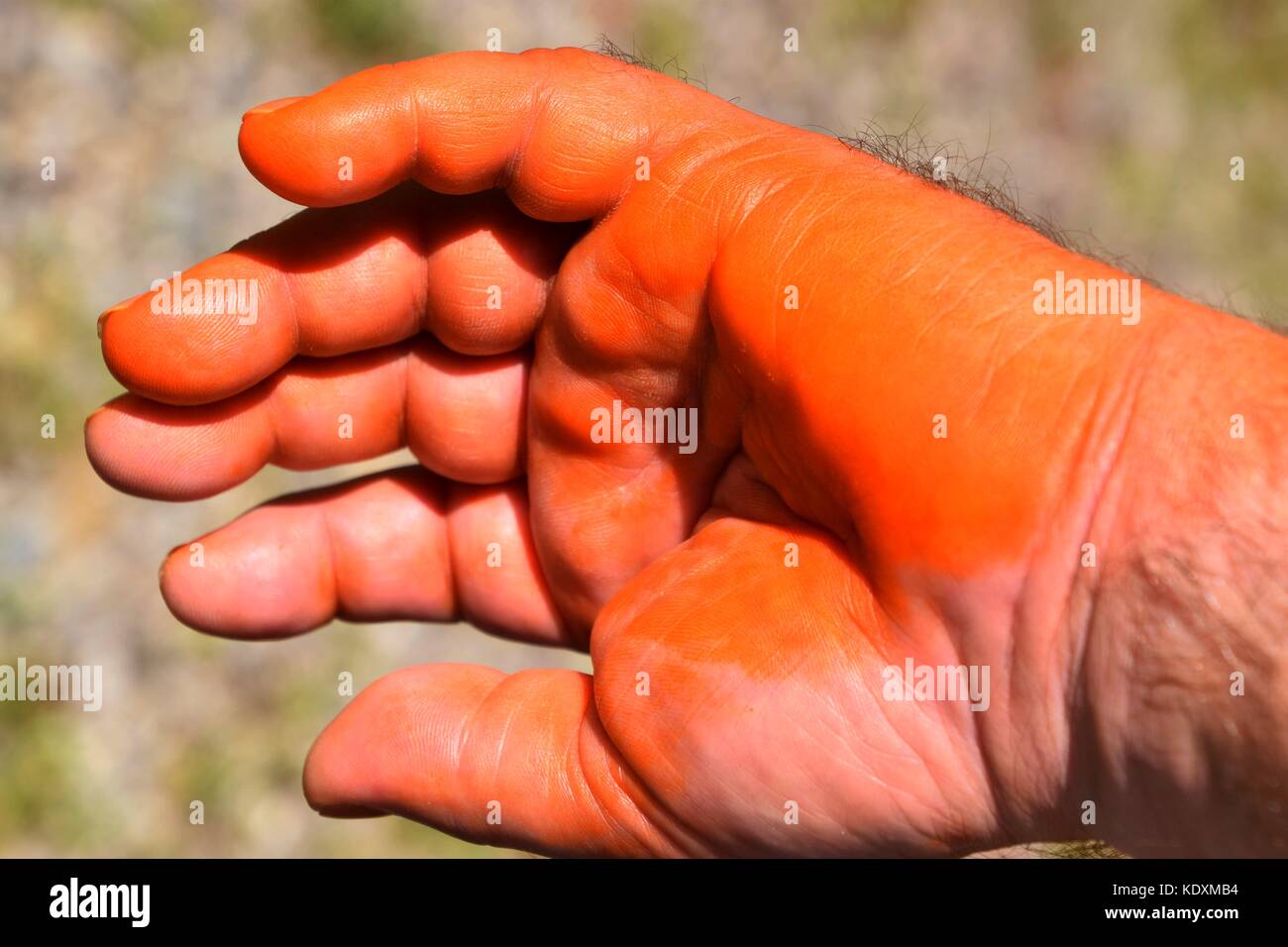 Swollen Hand Stockfotos Und Bilder Kaufen Alamy