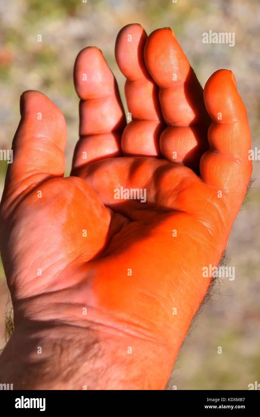 Nach einer Operation geschwollenen Mann´s Hand gereinigt mit Jod  Desinfektionsmittel Stockfotografie - Alamy