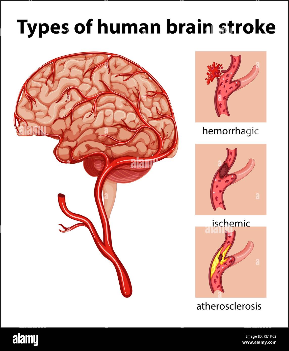 Arten des menschlichen Gehirns Schlaganfall Abbildung Stock Vektor