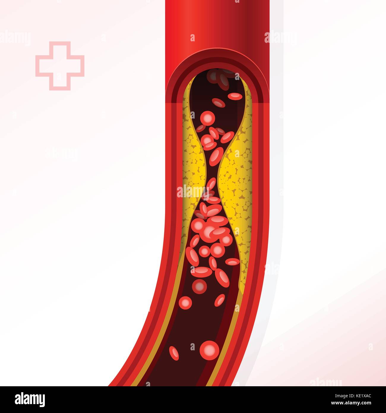 Arterie Abschnitt mit Cholesterin Anhaftungen - Cholesterin und Thrombosen Stock Vektor