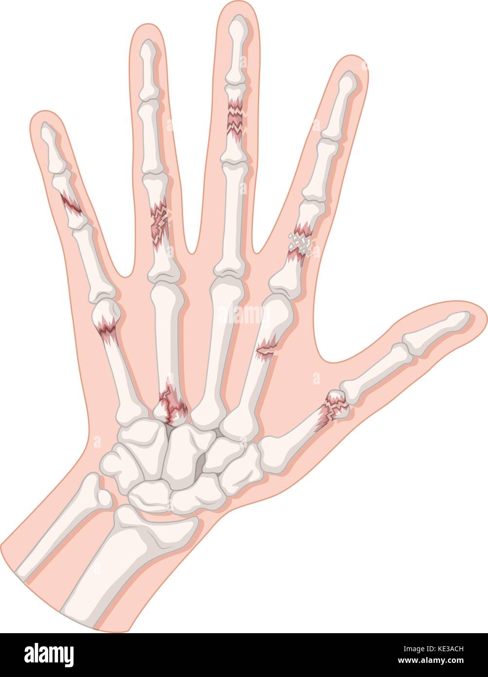 Gebrochene Knochen in der menschlichen Hand Abbildung Stock Vektor