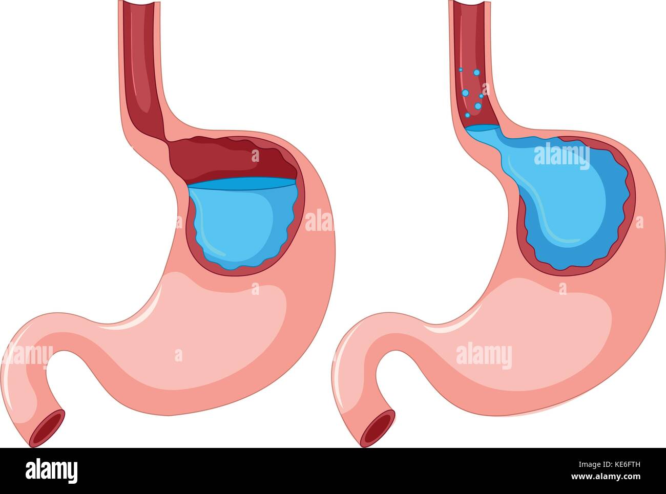 Diagramm der gastroösophagealen RefluxKrankheit Abbildung Stock