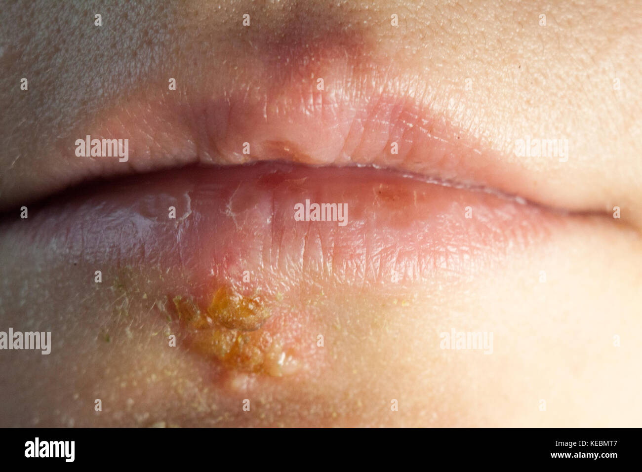 Herpes auf den Lippen des jungen Frau Stockfoto