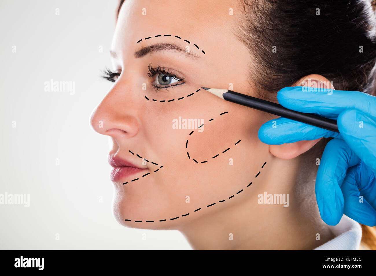 Nahaufnahme eines Chirurgen Korrektur Zeichnen von Linien auf junge Frau Gesicht für Plastische Chirurgie Stockfoto