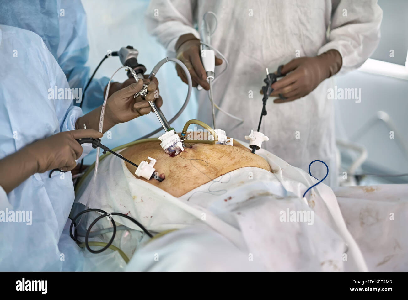 Chirurgen werden mit Hilfe der Laparoskopie Kameras in der Bauchhöhle des Patienten während der