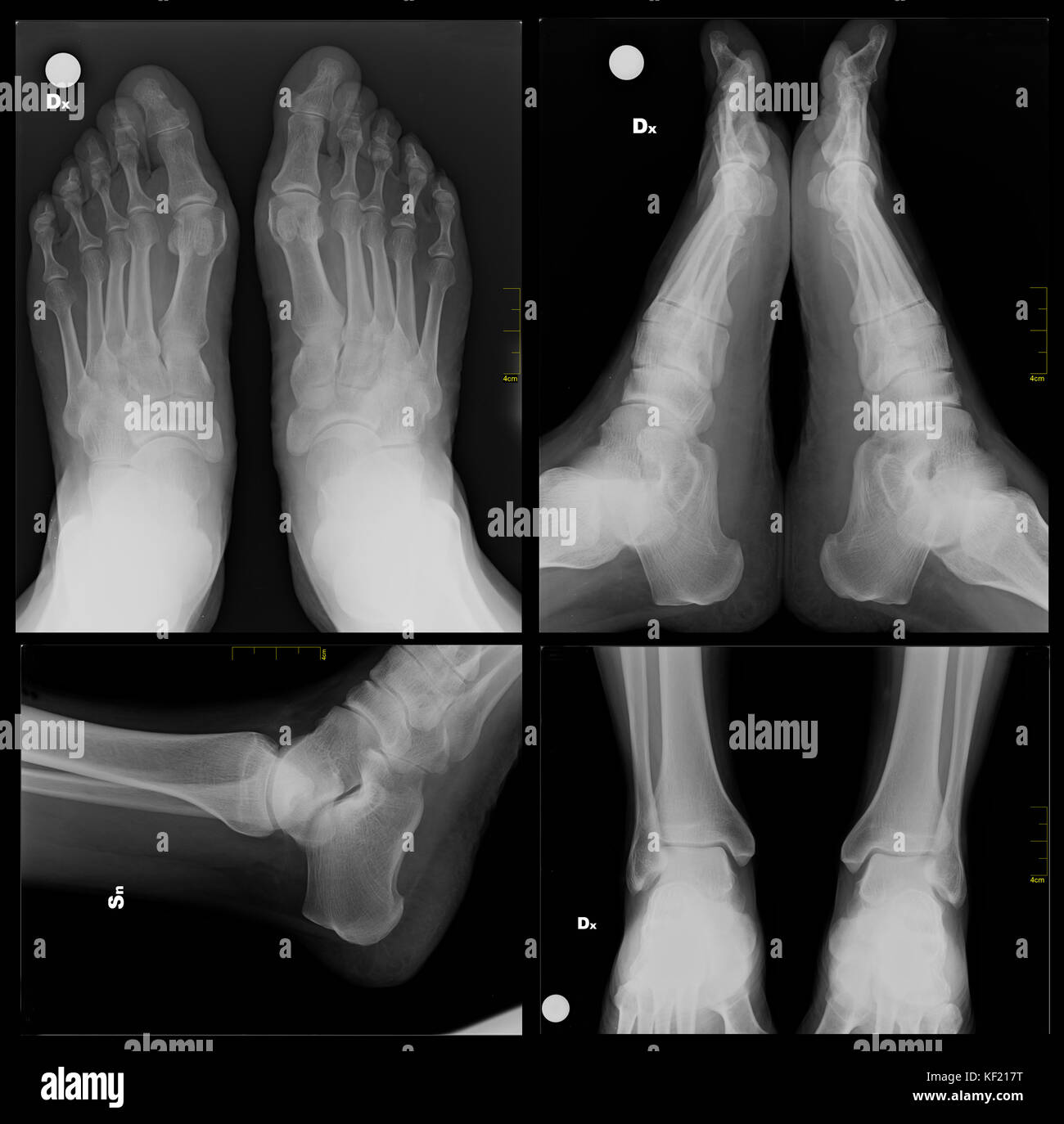 Röntgen fuß -Fotos und -Bildmaterial in hoher Auflösung – Alamy