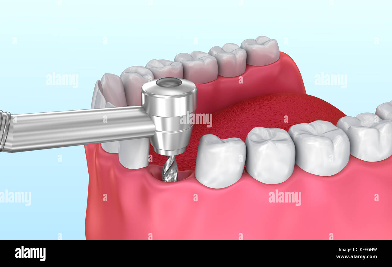 Zahn installation Implantat, Medizinisch genaue 3D-Darstellung Stockfoto