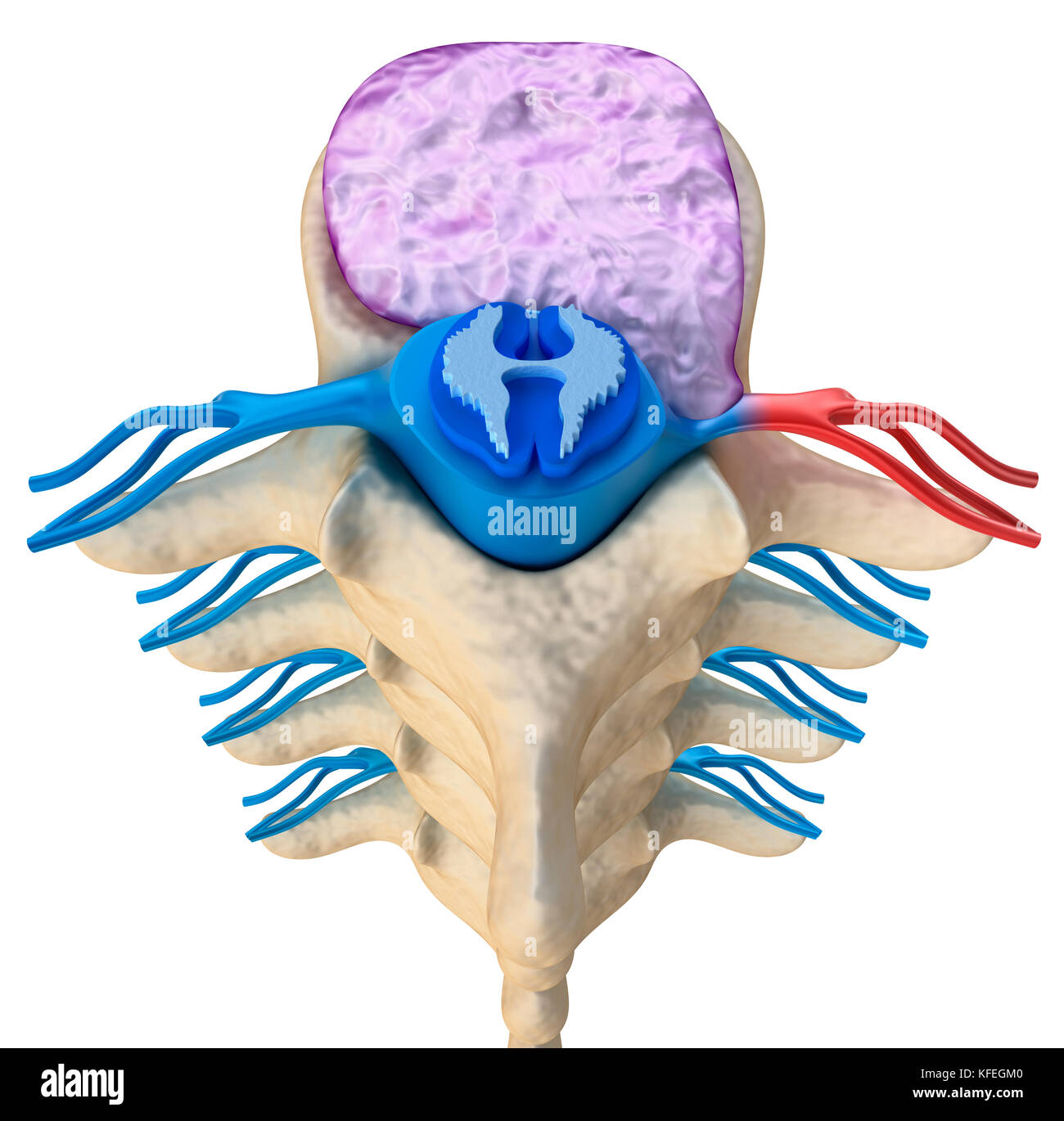 Rückenmark unter dem Druck der ausbauchende Scheibe, 3D-Darstellung Stockfoto