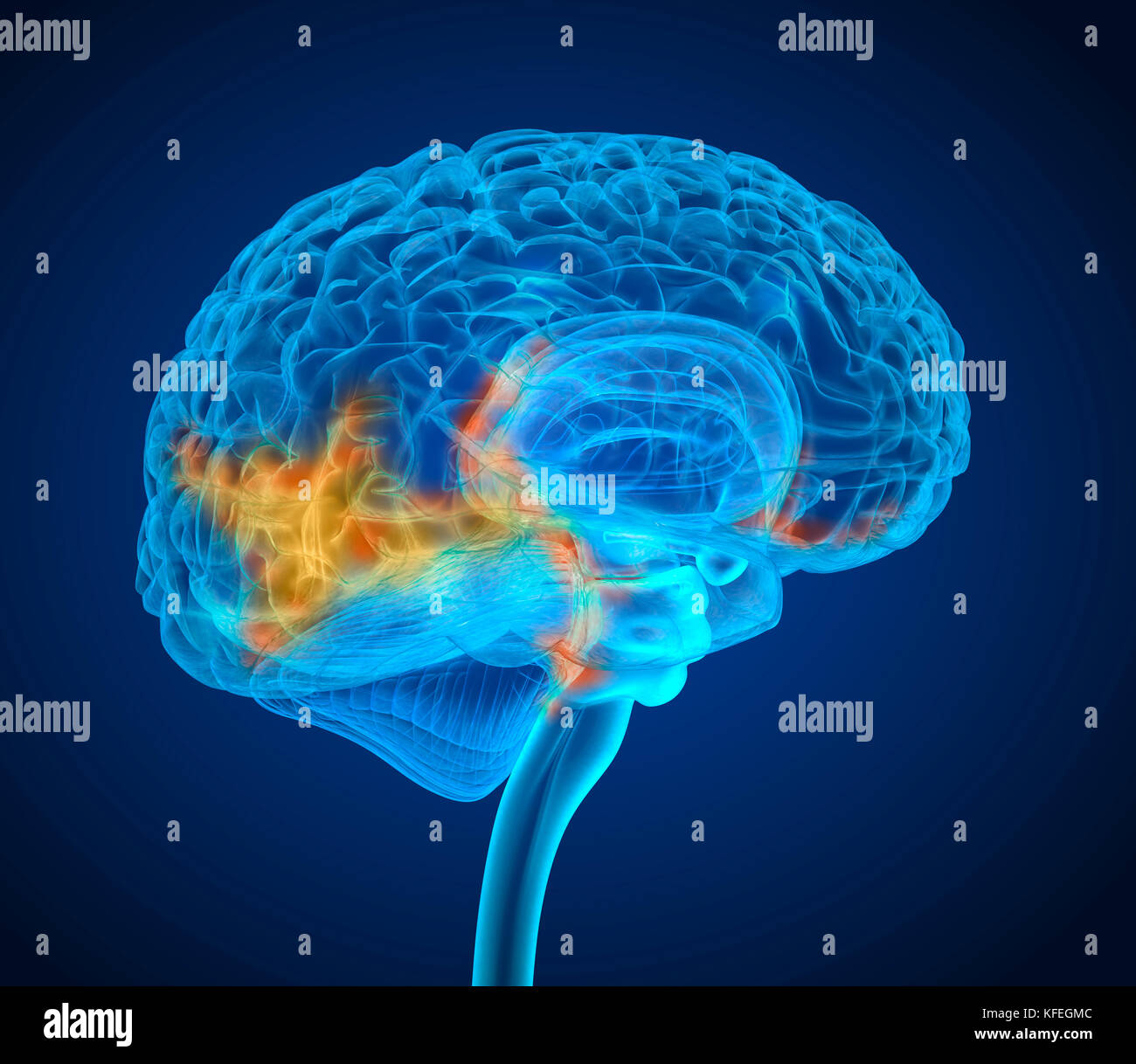 Human Brain Tumor X-ray-Scan, Medizinisch genaue 3D-Darstellung Stockfoto