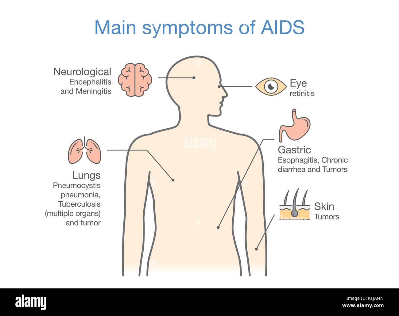 Darstellung der wichtigsten Symptome von Aids. Stock Vektor