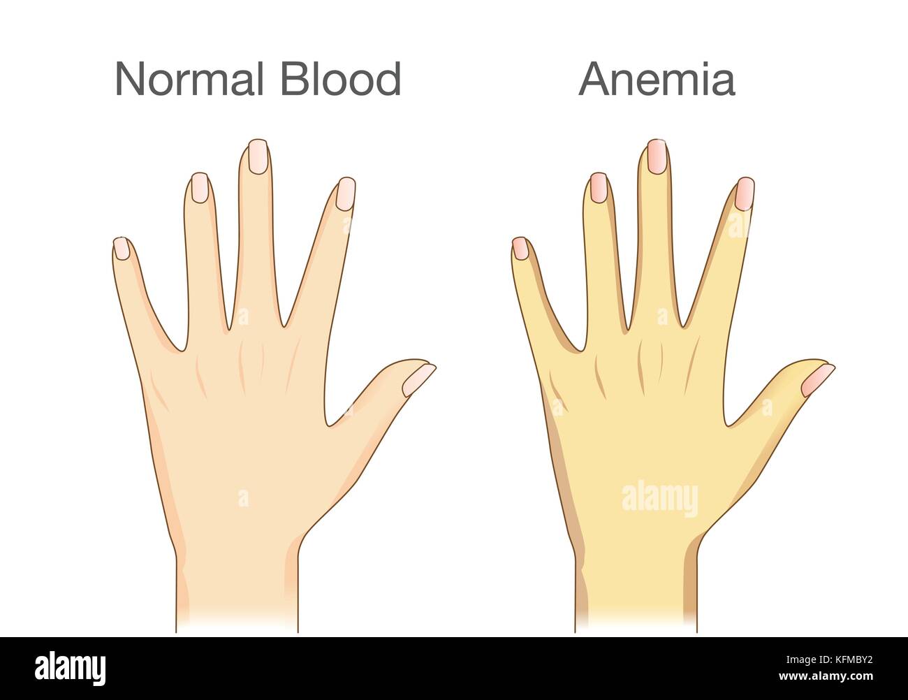 Der Unterschied der Anämie Menschen Haut und normale Menschen. Stock Vektor