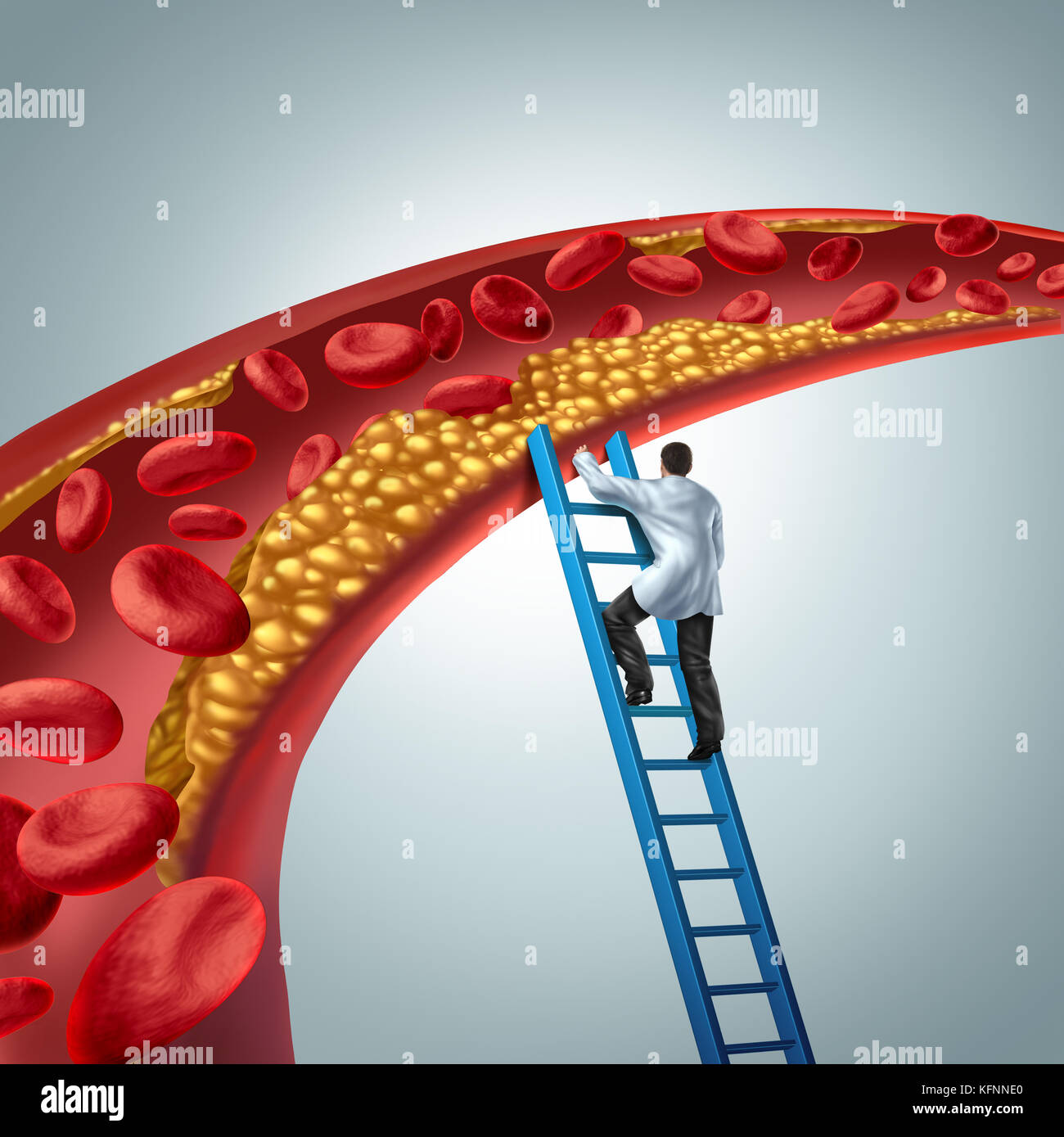 Cholesterin medizinische Diagnose Konzept als Arzt untersucht, Arteriosklerose oder arterielle Plaque eine Arterie verstopfen mit 3d-render Elemente. Stockfoto