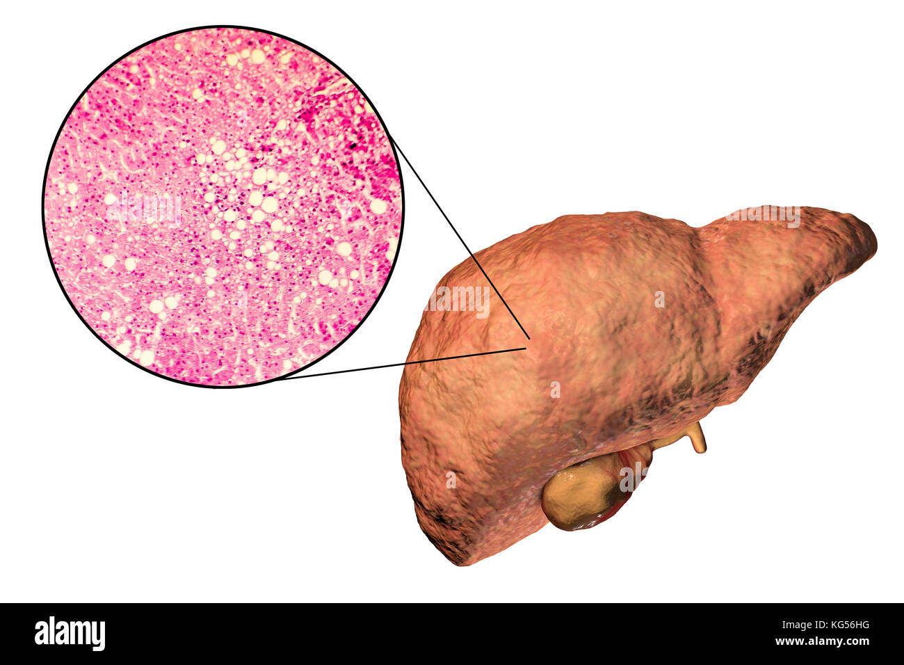 Fettleber. Computer Bild und Licht Schliffbild einer Sektion durch die Leber eines Patienten mit Fettleber. Fettleber ist häufig im Zusammenhang mit Alkohol oder das metabolische Syndrom (Diabetes, Bluthochdruck und Übergewicht), kann aber auch durch eine von vielen Ursachen sein. Fettleber ist ein reversibler Zustand, worin Große Vakuole von Fett (blass gelbe Kreise) sammeln sich in den Leberzellen. Stockfoto