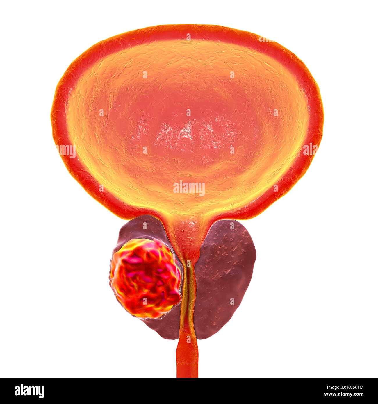 Prostatakrebs. Computer Abbildung eines cancerous Tumor (Mitte links) in der Prostata (dunkelrot, Mitte). Die harnröhre können gesehen werden in der Mitte der Prostata, von der Blase (oben). Prostatakrebs ist eine der häufigsten männlichen Krebse, das gewöhnlich die älteren Menschen. Das Wachstum der Prostata Tumor kann behindern den Hals der Blase, Wasserlassen beeinträchtigt. Es ist jedoch ein langsam wachsender Krebs. Wenn Sie bestimmt, Behandlung beinhaltet die Operation der Prostata zu entfernen, oder Strahlentherapie. Stockfoto