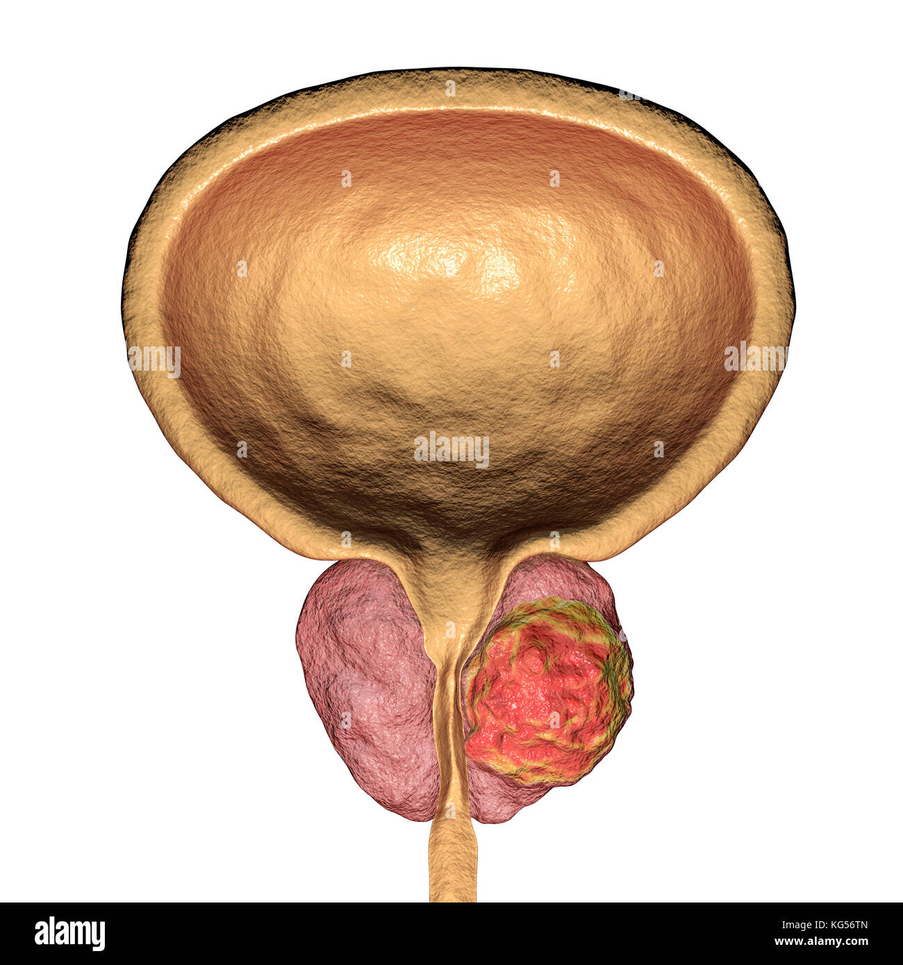 Prostatakrebs. Computer Abbildung eines cancerous Tumor (Mitte rechts) in der Prostata (rosa, Mitte). Die harnröhre können gesehen werden in der Mitte der Prostata, von der Blase (oben). Prostatakrebs ist eine der häufigsten männlichen Krebse, das gewöhnlich die älteren Menschen. Das Wachstum der Prostata Tumor kann behindern den Hals der Blase, Wasserlassen beeinträchtigt. Es ist jedoch ein langsam wachsender Krebs. Wenn Sie bestimmt, Behandlung beinhaltet die Operation der Prostata zu entfernen, oder Strahlentherapie. Stockfoto
