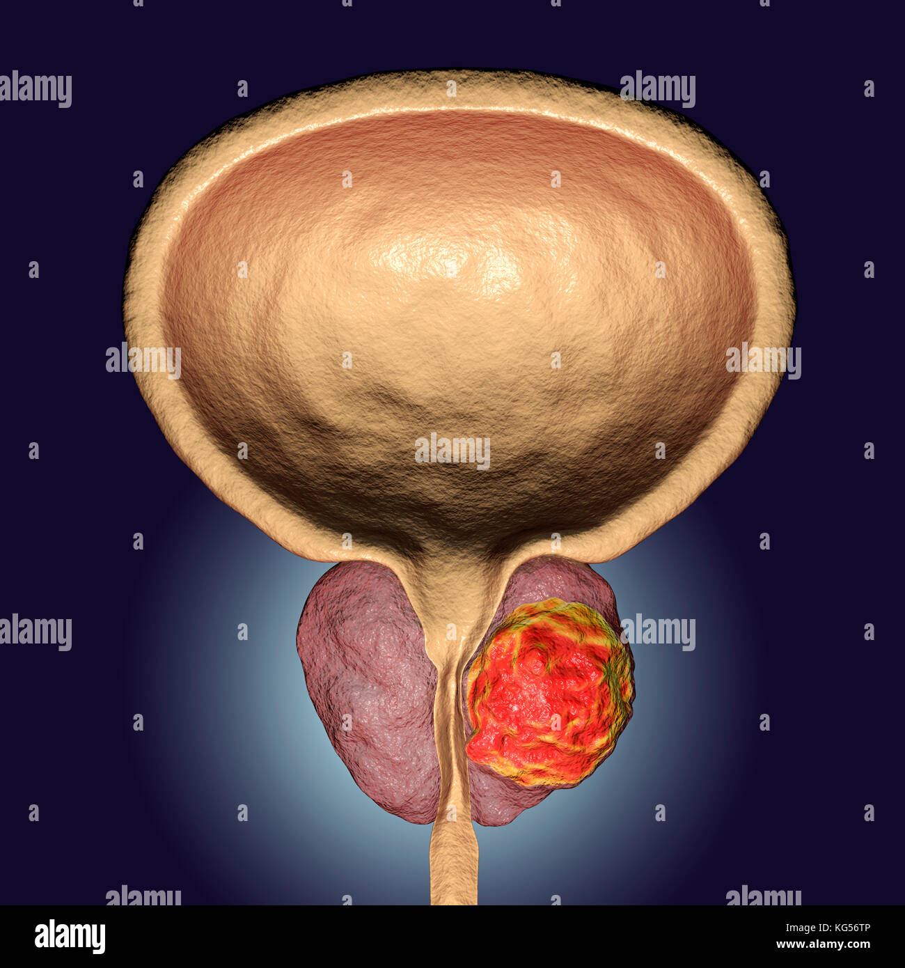 Prostatakrebs Computer Abbildung Eines Cancerous Tumor Mitte Rechts prostatakrebs-computer-abbildung-eines-cancerous-tumor-mitte-rechts