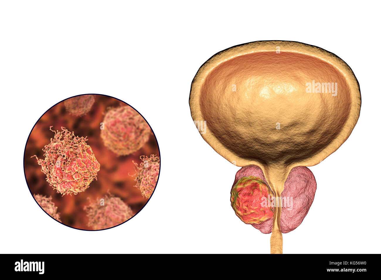Prostatakrebs. Computer Abbildung eines cancerous Tumor in der Prostata (rechts) und in der Nähe der Prostata Krebszellen (links). Die harnröhre können gesehen werden in der Mitte der Prostata, von der Blase (oben). Prostatakrebs ist eine der häufigsten männlichen Krebse, das gewöhnlich die älteren Menschen. Das Wachstum der Prostata Tumor kann behindern den Hals der Blase, Wasserlassen beeinträchtigt. Es ist jedoch ein langsam wachsender Krebs. Wenn Sie bestimmt, Behandlung beinhaltet die Operation der Prostata zu entfernen, oder Strahlentherapie. Stockfoto