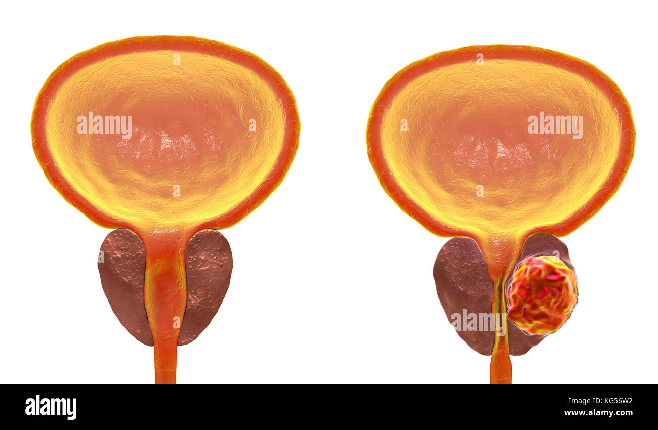 Prostatakrebs. Computer Abbildung eines cancerous Tumor in der Prostata (rechts) und gesunde Prostata (links). Die harnröhre können gesehen werden in der Mitte der Prostata, von der Blase (oben). Prostatakrebs ist eine der häufigsten männlichen Krebse, das gewöhnlich die älteren Menschen. Das Wachstum der Prostata Tumor kann behindern den Hals der Blase, Wasserlassen beeinträchtigt. Es ist jedoch ein langsam wachsender Krebs. Wenn Sie bestimmt, Behandlung beinhaltet die Operation der Prostata zu entfernen, oder Strahlentherapie. Stockfoto