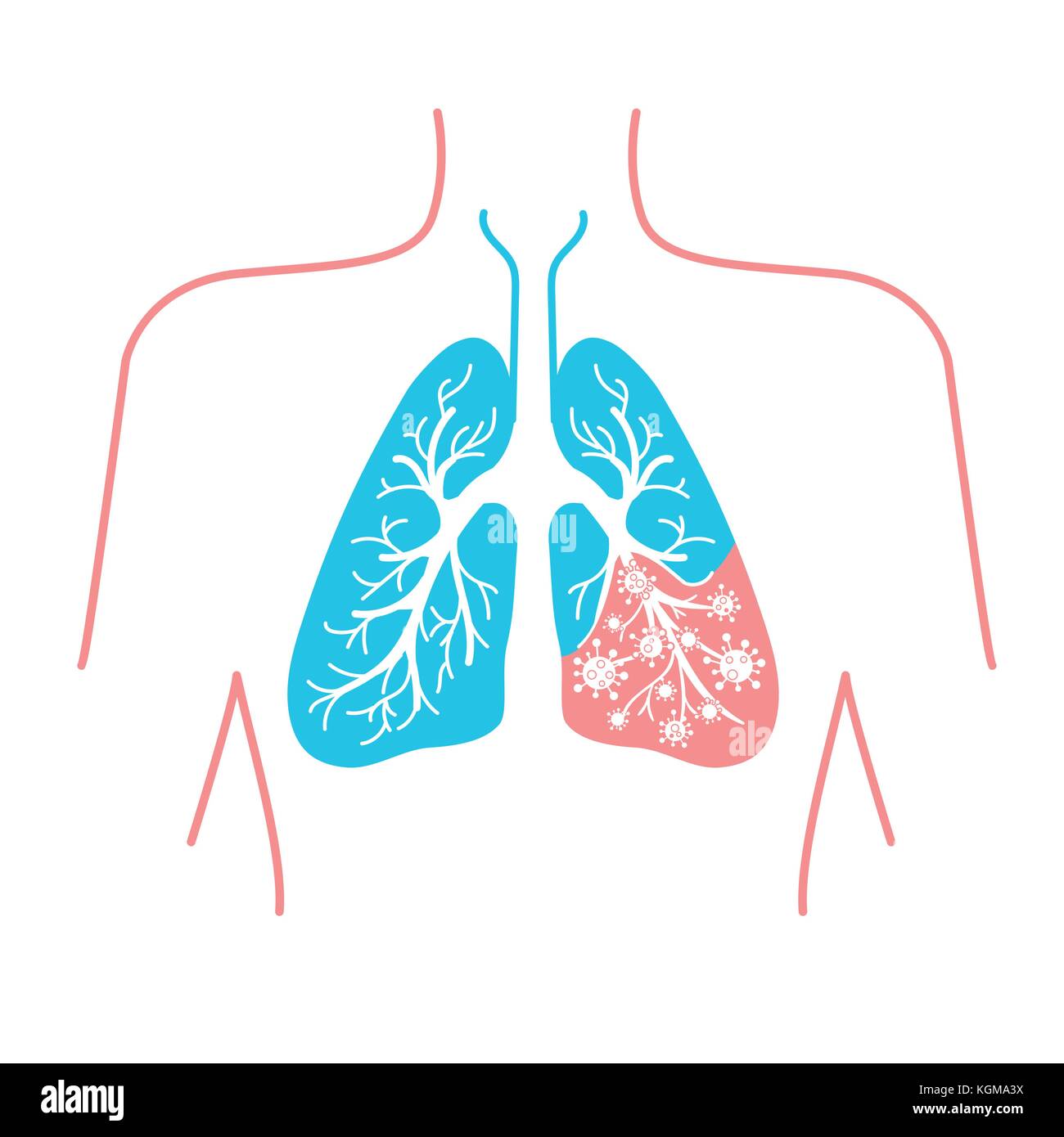 Symbol der Lungenkrankheit, Pneumonie, Asthma, Krebs in der Form von Lungenkrebs Anatomie und Viren verursacht Krankheit. Symbol in linearen Stil Stock Vektor