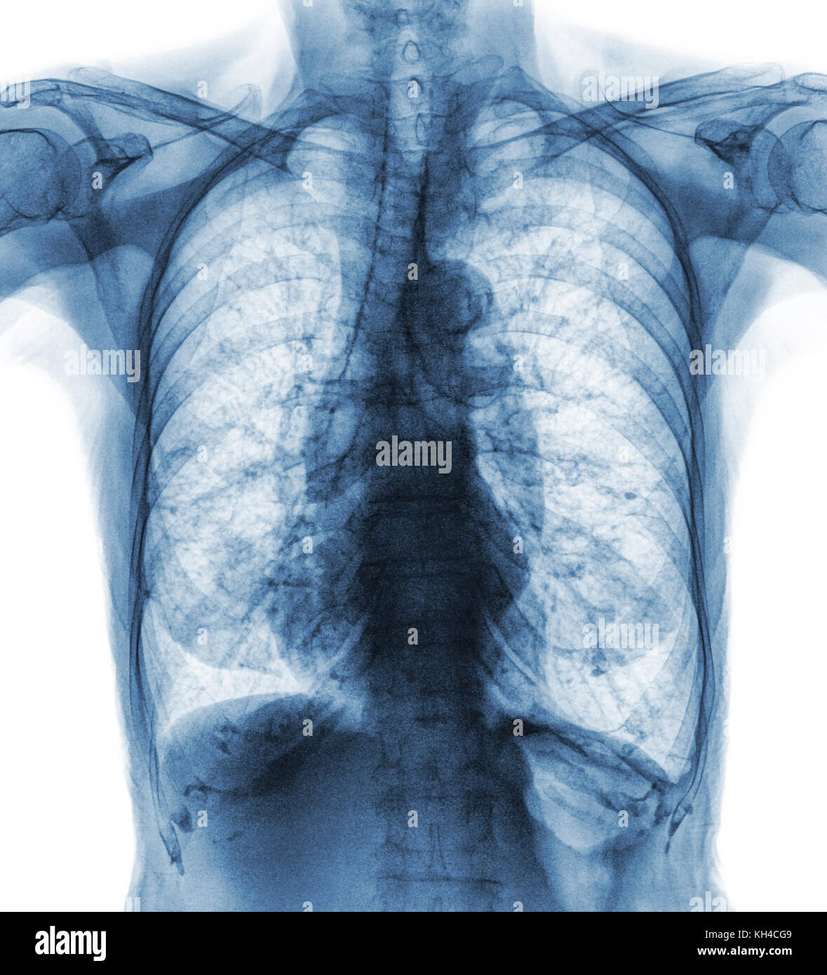 Die normale Thoraxröntgenuntersuchung des alten Patienten. Sie können Verkalkungen an Rippen, Luftröhre, Bronchus sehen. Vorderansicht . Stockfoto