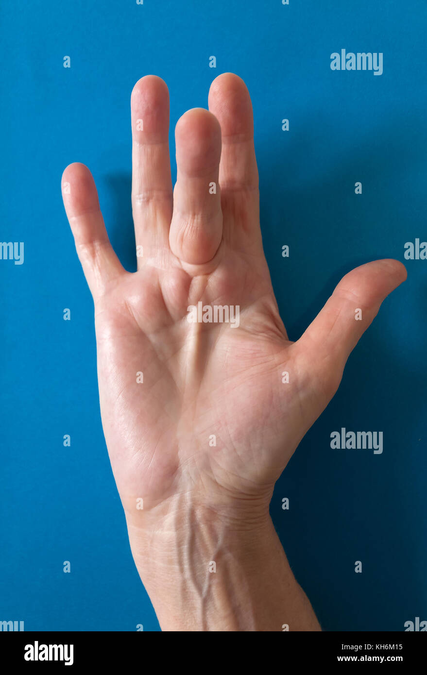 Dupuytren Kontraktur der Deformität: eine Schnur in der Hand (mit einem harten Knötchen an der Basis des Mittelfingers) zieht den Finger in eine verbogene Position. Stockfoto